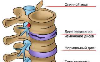 Остеохондроз с корешковым синдромом массаж