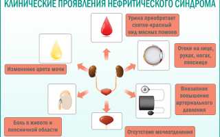 Дифференциальная диагностика нефротического и нефротического синдромов