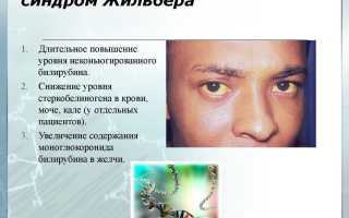 Болит ли голова при синдроме жильбера