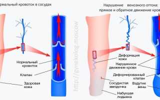 Синдром застоя в малом тазу что это