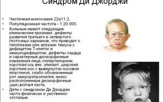 Синдром ди джорджи фото детей