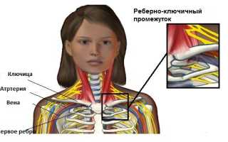 Лечение скаленус синдрома в москве