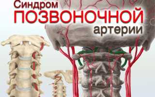 Синдром позвоночной артерии симптомы видео