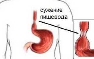 Рубцовый стеноз пищевода код мкб