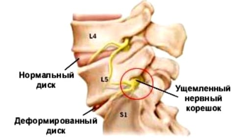 Лечение народное корешковый синдром позвоночника
