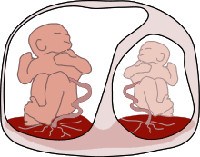Фето-фетальный трансфузионный синдром