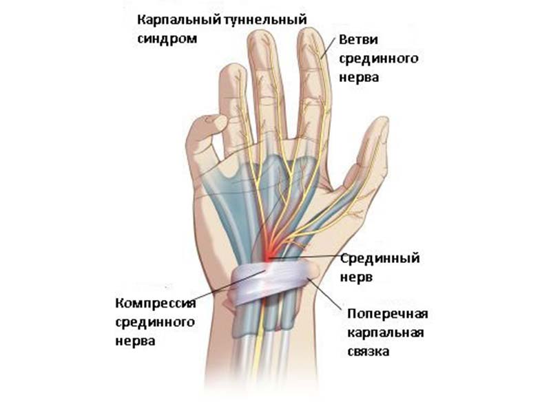 Нейропатическая причина синдрома Зудека.jpg