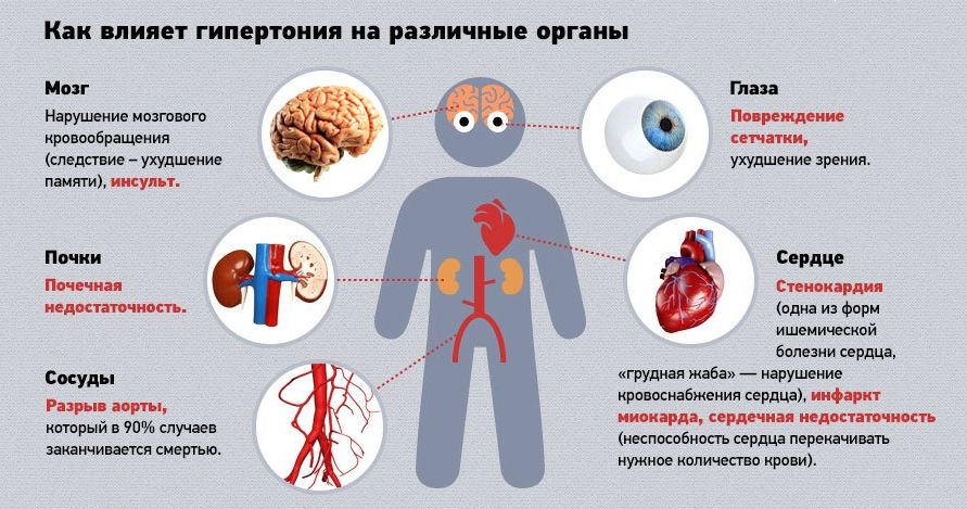 Синдром раздражения позвоночной артерии по мкб