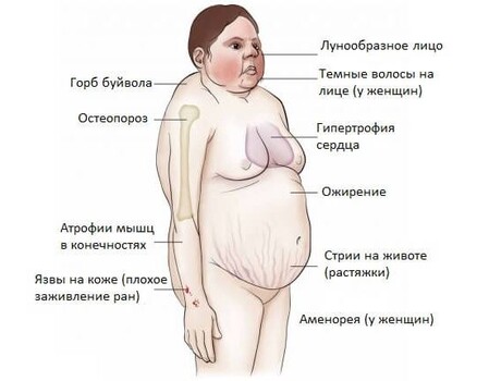 Фото при синдроме иценко кушинга