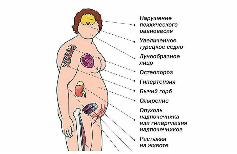 Причиной развития синдрома иценко кушинга является