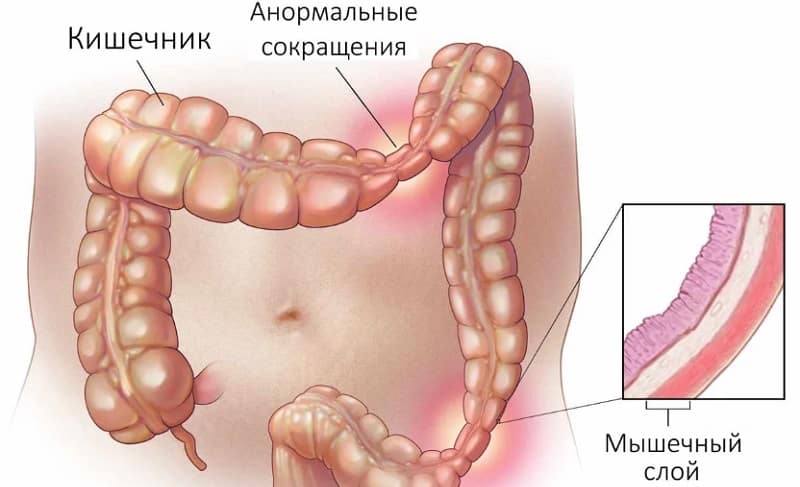 Первые признаки и особенности лечения синдрома раздраженного кишечника у детей