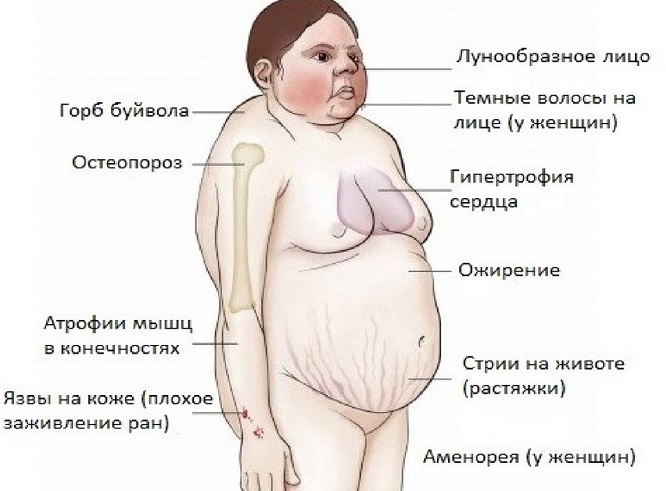 Фото при синдроме иценко кушинга