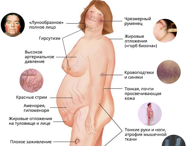 Фото при синдроме иценко кушинга