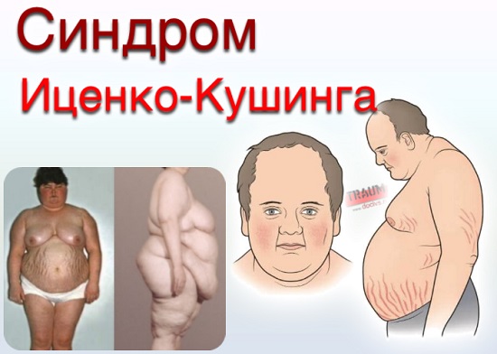 Фото при синдроме иценко кушинга
