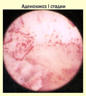 Аденомиоз 1 стадии