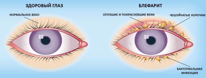 https://proglaza.net/lechenie/glaznye-kapli/ot-katarakty-i-glaukomy