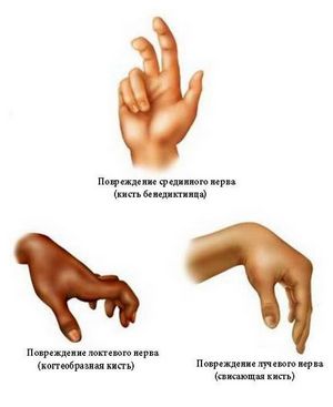 Нервы кисти при повреждении при травмах и заболеваниях.jpg