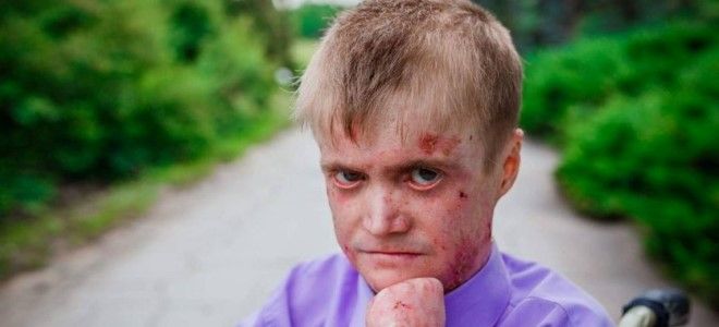 пограничный буллезный эпидермолиз
