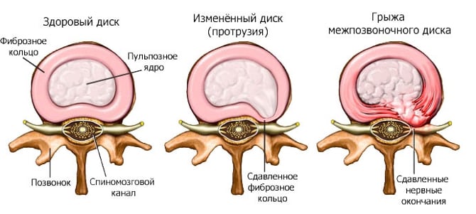 Лечение народное корешковый синдром позвоночника