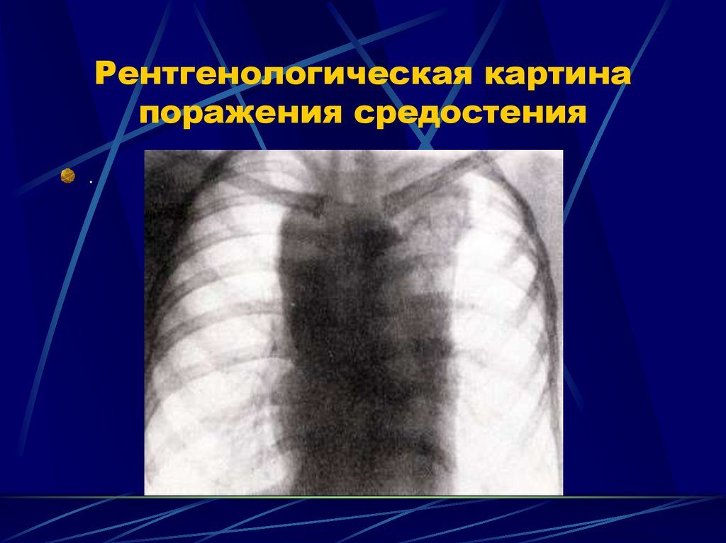 Лимфоузлы средостения код по мкб 10