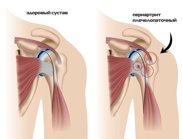 Чем снять болевой синдром в плечевом суставе