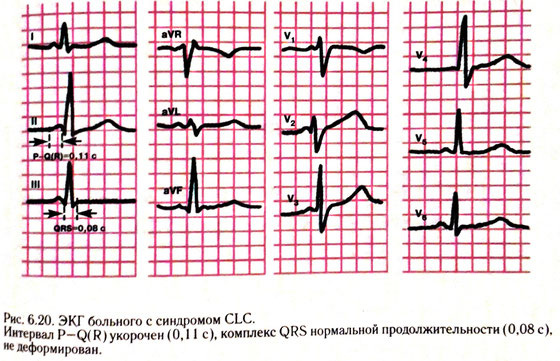 Clc синдром экг что это такое