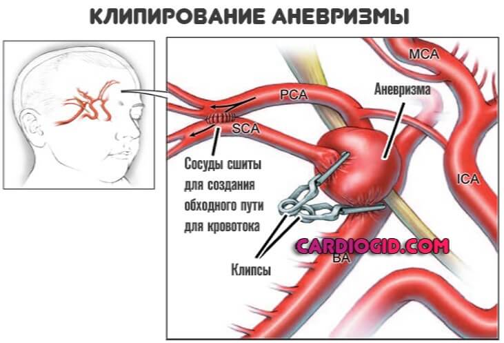 клипирование аневризмы головного мозга