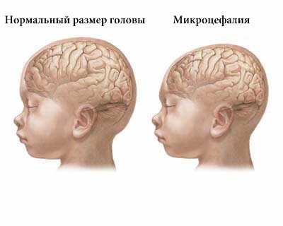 Микроцефалия