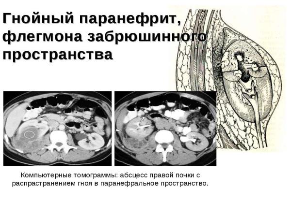 Диагностика, лечение и последствия паранефрита