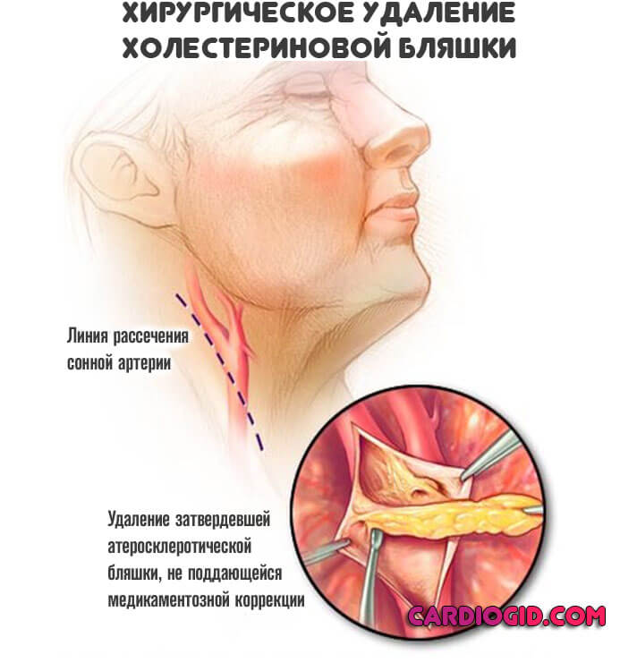 удаление-затвердевшей-атеросклеротической-бляшки