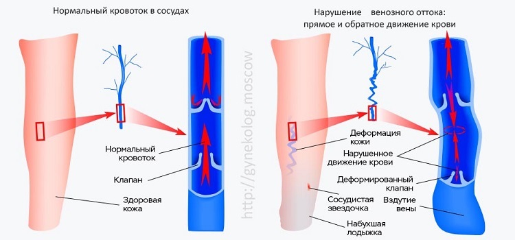 Как образуется варикозное расширение вен малого таза