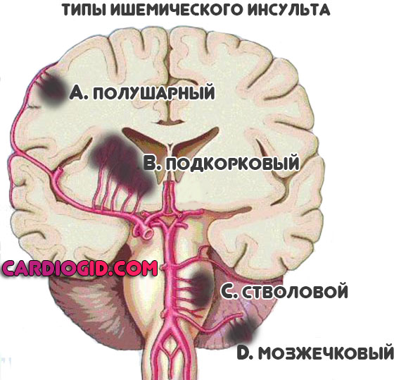 виды-ишемического-инсульта